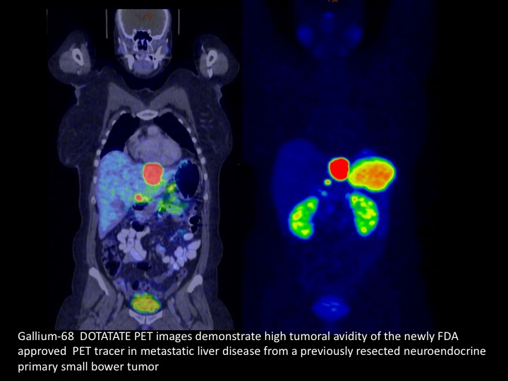 Ga-68 DOTATATE of Neuroendocrine Tumors | Department of Radiology